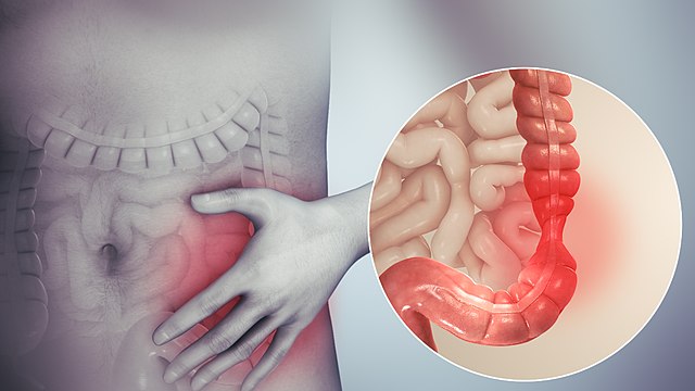 سندروم روده تحریک پذیر